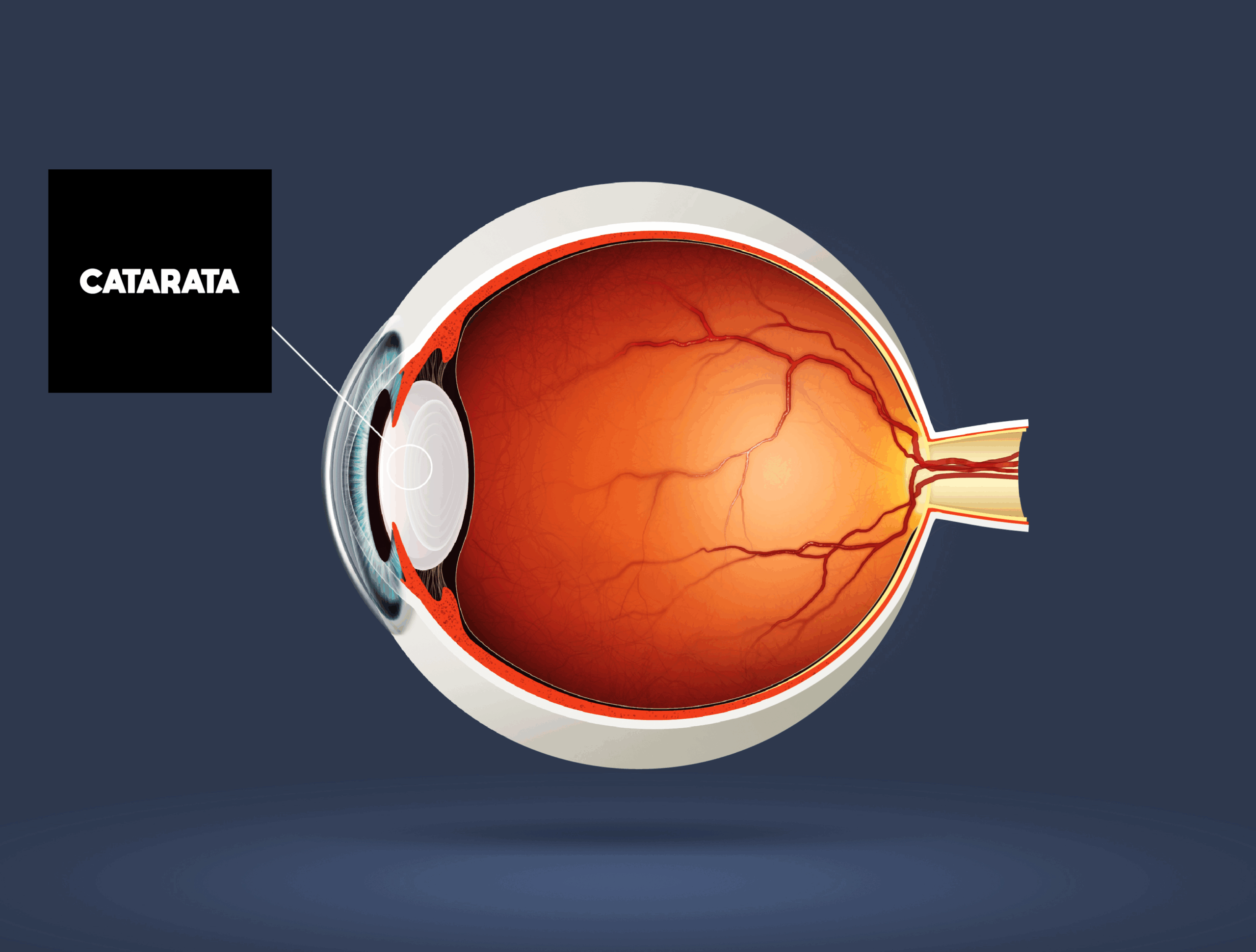 Cirurgia de catarata